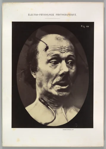 Figure 60: Fright by Guillaume Benjamin Amand Duchenne de Boulogne, photograph, 1854-1856