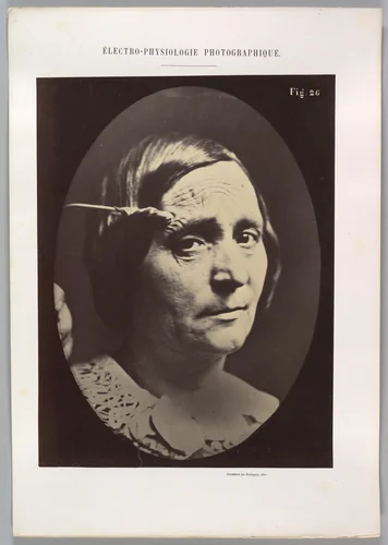 Figure 26: Expression of painful attention and attention, attentive gaze. by Guillaume Benjamin Amand Duchenne de Boulogne, photograph, 1854-1856