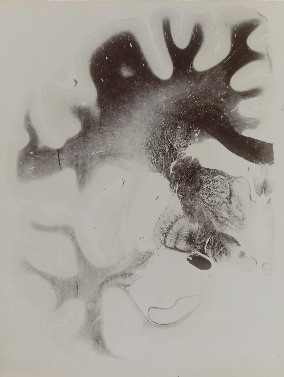 Map of the Brain: Cross-Section I, Frontal Section Plate 13 from an album published by The Psychiatric Clinic of Breslau by Unidentified Photographer, photograph, 1915