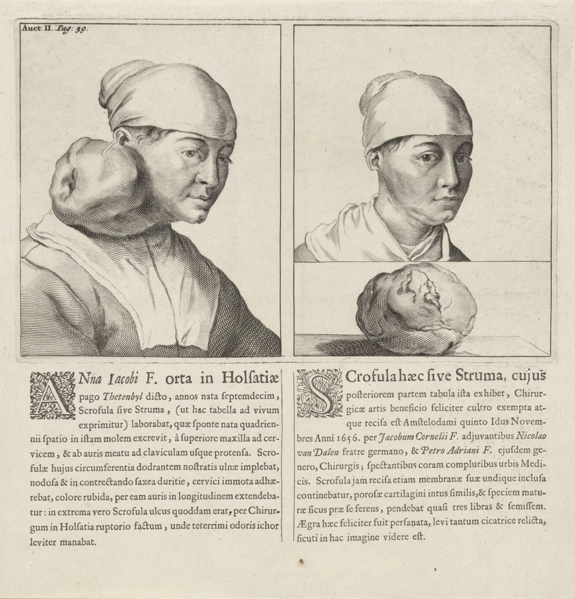 Anneke Jacobs van Thetenbul vóór en ná een operatie van een tumor by Cornelis Visscher, print, 1693