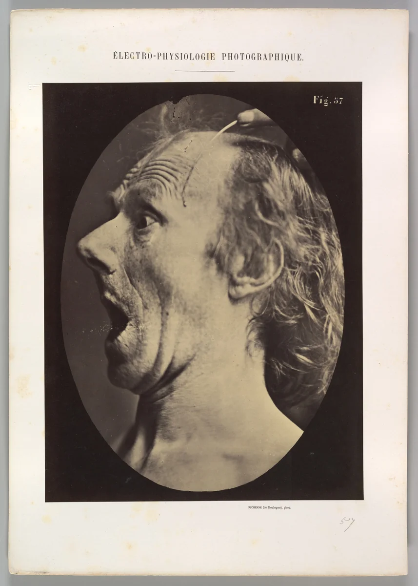 Figure 57: Astonishment, stupefaction, amazement by Guillaume Benjamin Amand Duchenne de Boulogne, photograph, 1854-1856