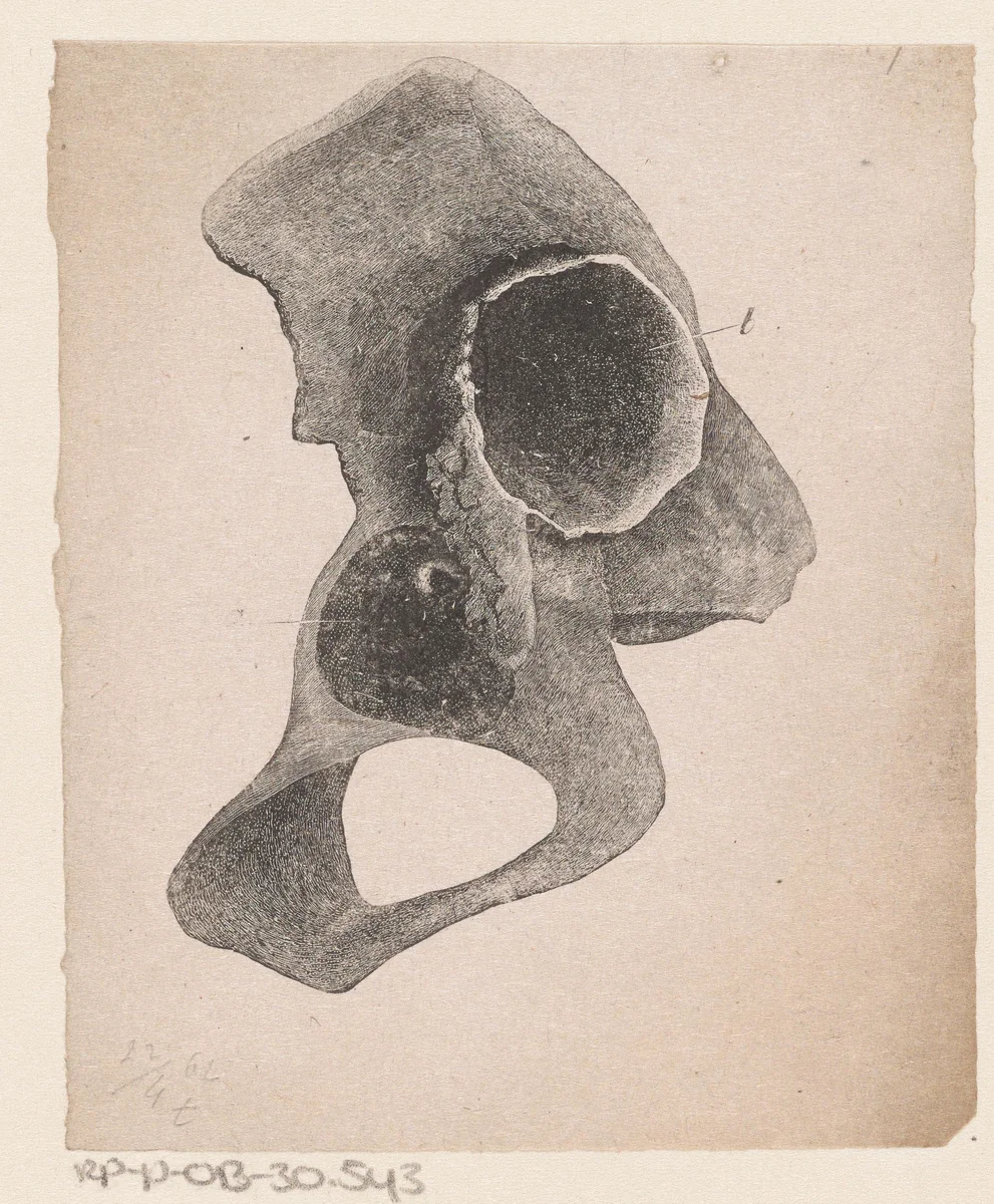 Menselijk bot met een afwijking by Isaac Weissenbruch, print, 1836-1912