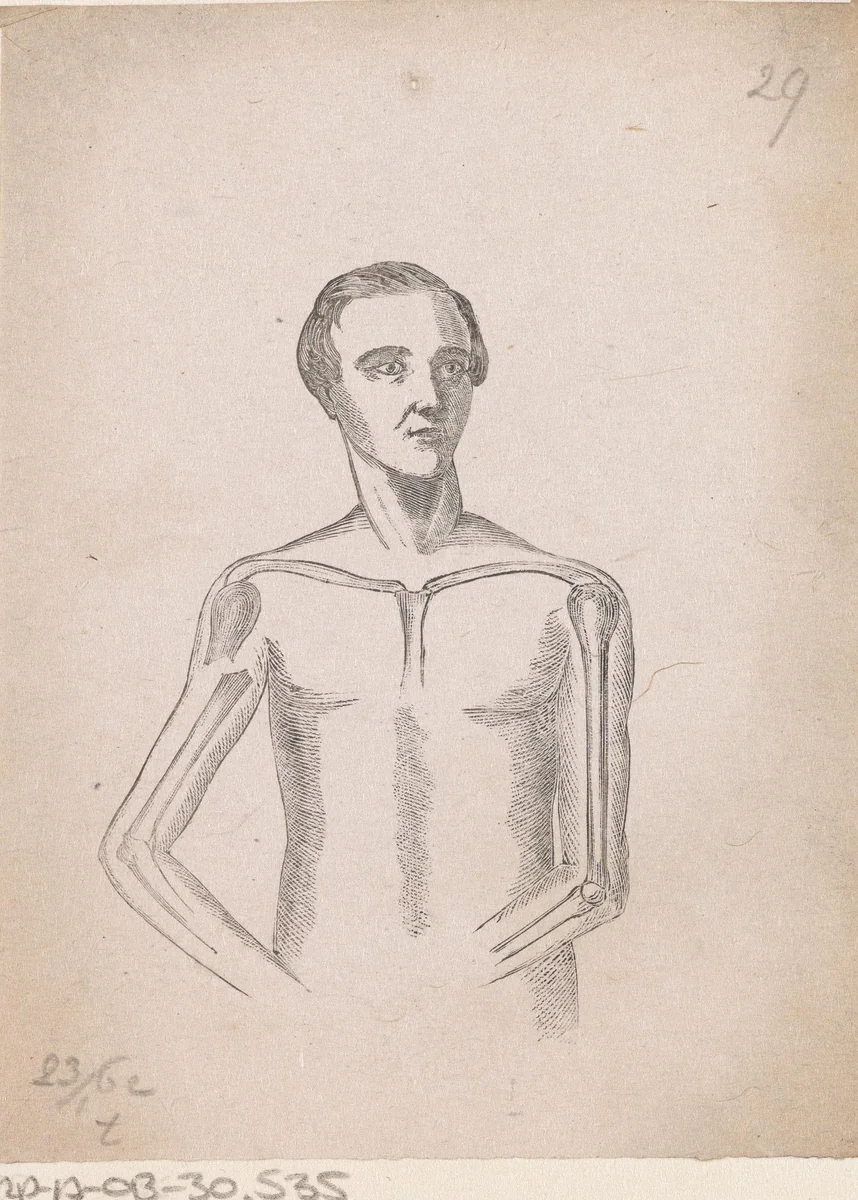 Man met een breuk in de rechter bovenarm by Isaac Weissenbruch, print, 1836-1912