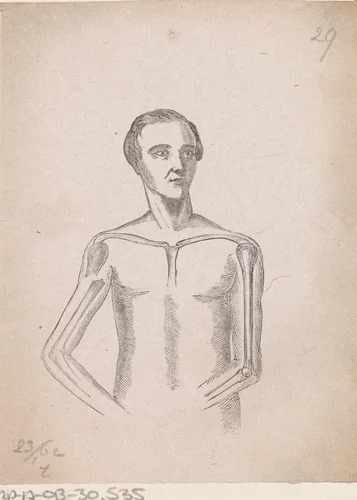 Man met een breuk in de rechter bovenarm by Isaac Weissenbruch, print, 1836-1912