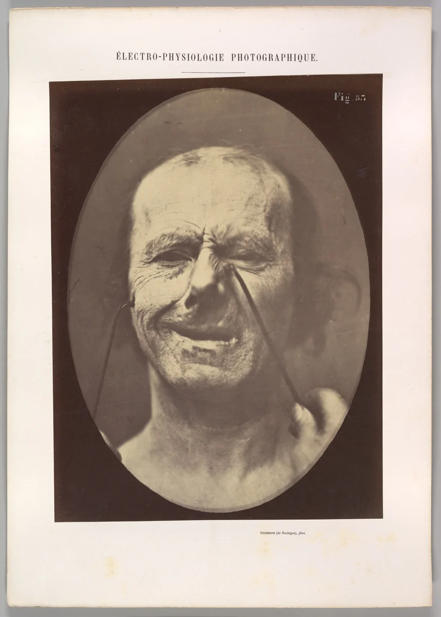 Figure 53: Whimpering and false laughter by Guillaume Benjamin Amand Duchenne de Boulogne, photograph, 1854-1856