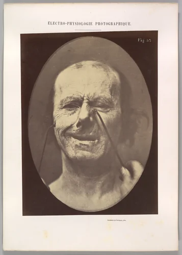 Figure 53: Whimpering and false laughter by Guillaume Benjamin Amand Duchenne de Boulogne, photograph, 1854-1856