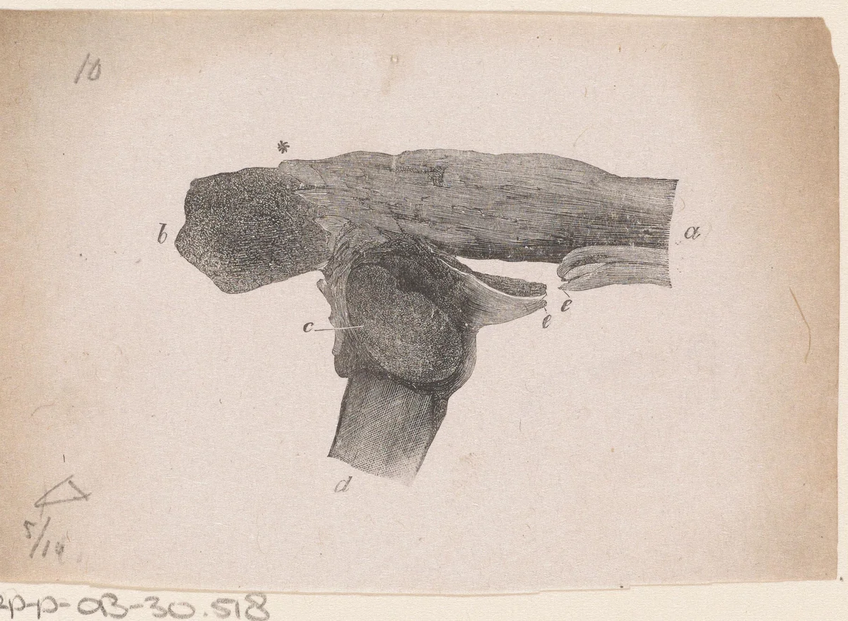 Menselijk bot met een breuk by Isaac Weissenbruch, print, 1836-1912