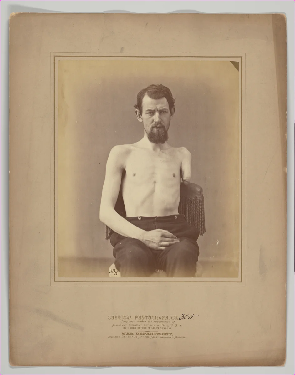Amputation of the Left Arm for Gunshot Injury by E. J. Ward, photograph, 1871