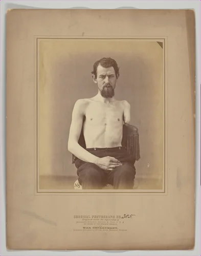 Amputation of the Left Arm for Gunshot Injury by E. J. Ward, photograph, 1871