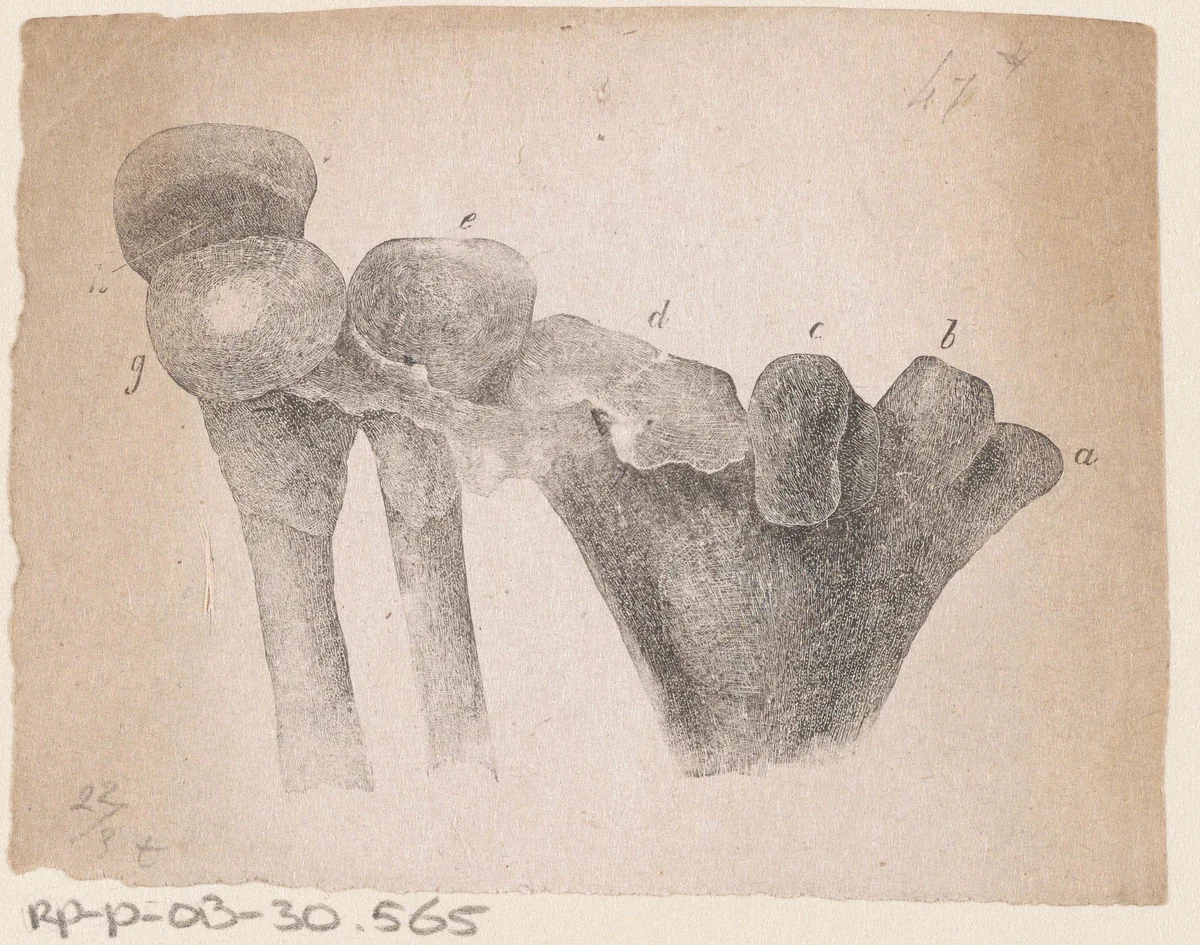 Menselijk bot met een afwijking by Isaac Weissenbruch, print, 1836-1912