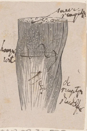 Onderdeel van het menselijk lichaam met een afwijking by Isaac Weissenbruch, print, 1836-1912