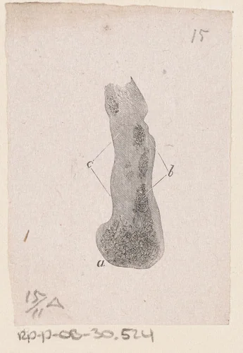Menselijk bot met een afwijking by Isaac Weissenbruch, print, 1836-1912