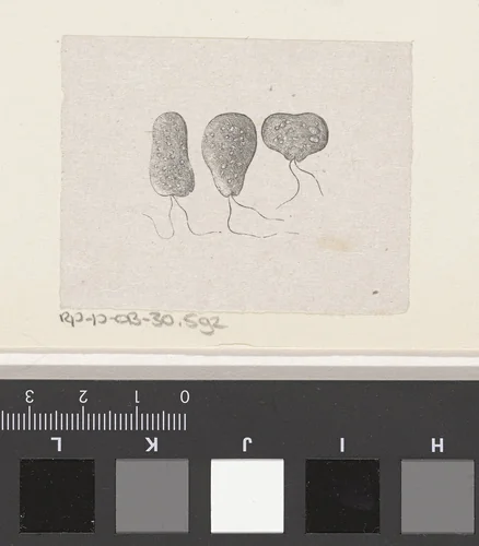 Onderdeel van het menselijk lichaam met een afwijking by Isaac Weissenbruch, print, 1836-1912