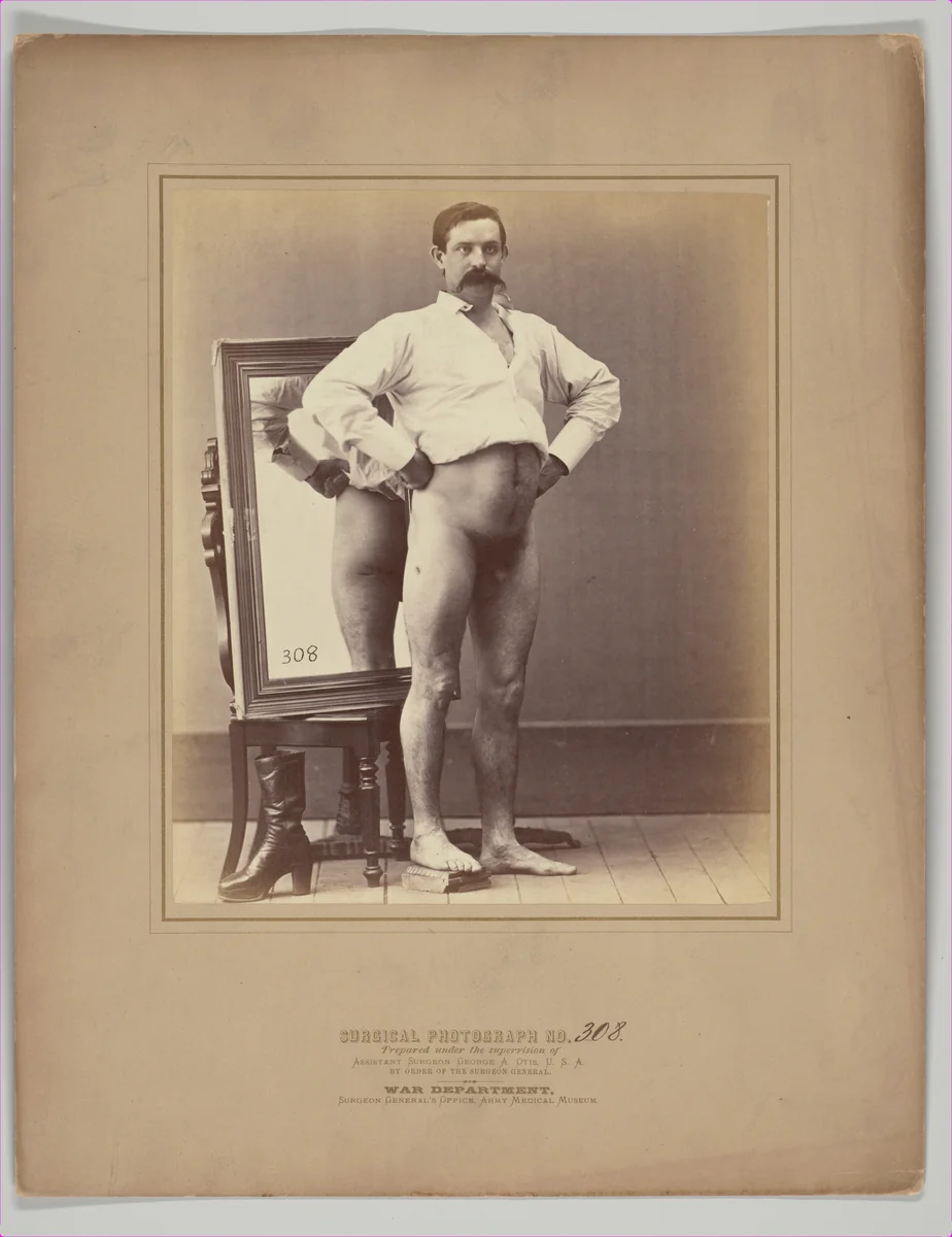 A Compound Comminuted Fracture of the Femur Successfully Treated with Smith's Anterior Splint by William H. Bell, photograph, 1864-1865