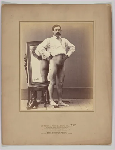 A Compound Comminuted Fracture of the Femur Successfully Treated with Smith's Anterior Splint by William H. Bell, photograph, 1864-1865