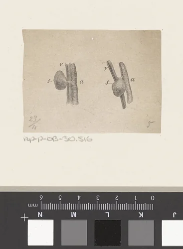Onderdeel van het menselijk lichaam met een afwijking by Isaac Weissenbruch, print, 1836-1912