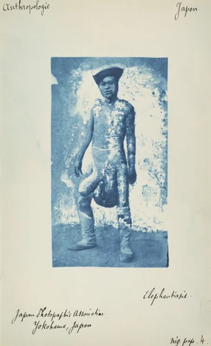 Elephantiasis by Unknown 19th Century, photograph, 1870-1879