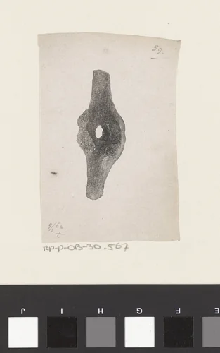 Onderdeel van het menselijk lichaam met een afwijking by Isaac Weissenbruch, print, 1836-1912