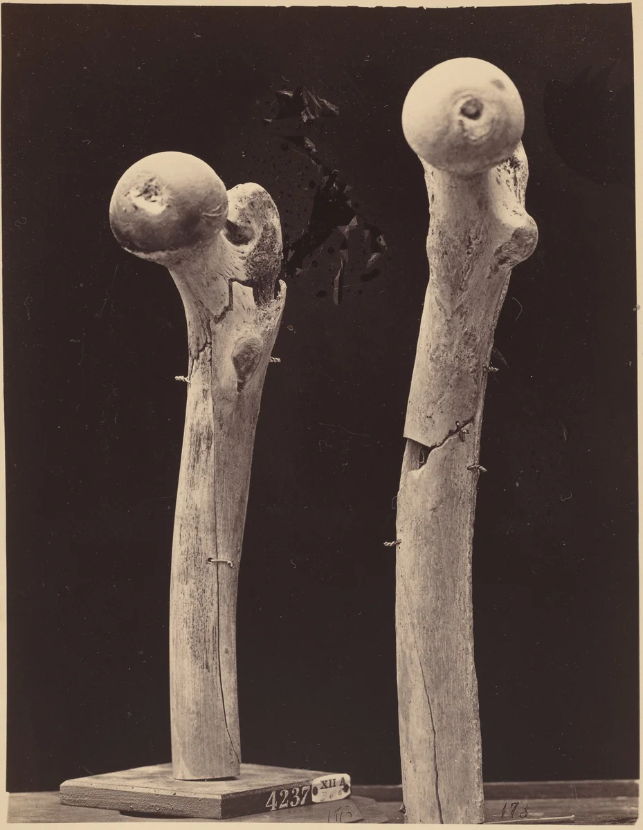 Specimens of Gunshot Fractures of the Femur by American 19th Century, photograph, 1865-1872