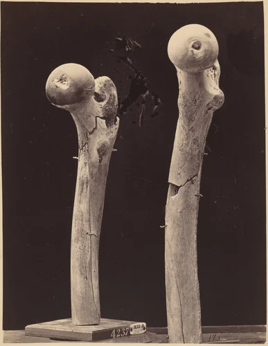 Specimens of Gunshot Fractures of the Femur by American 19th Century, photograph, 1865-1872