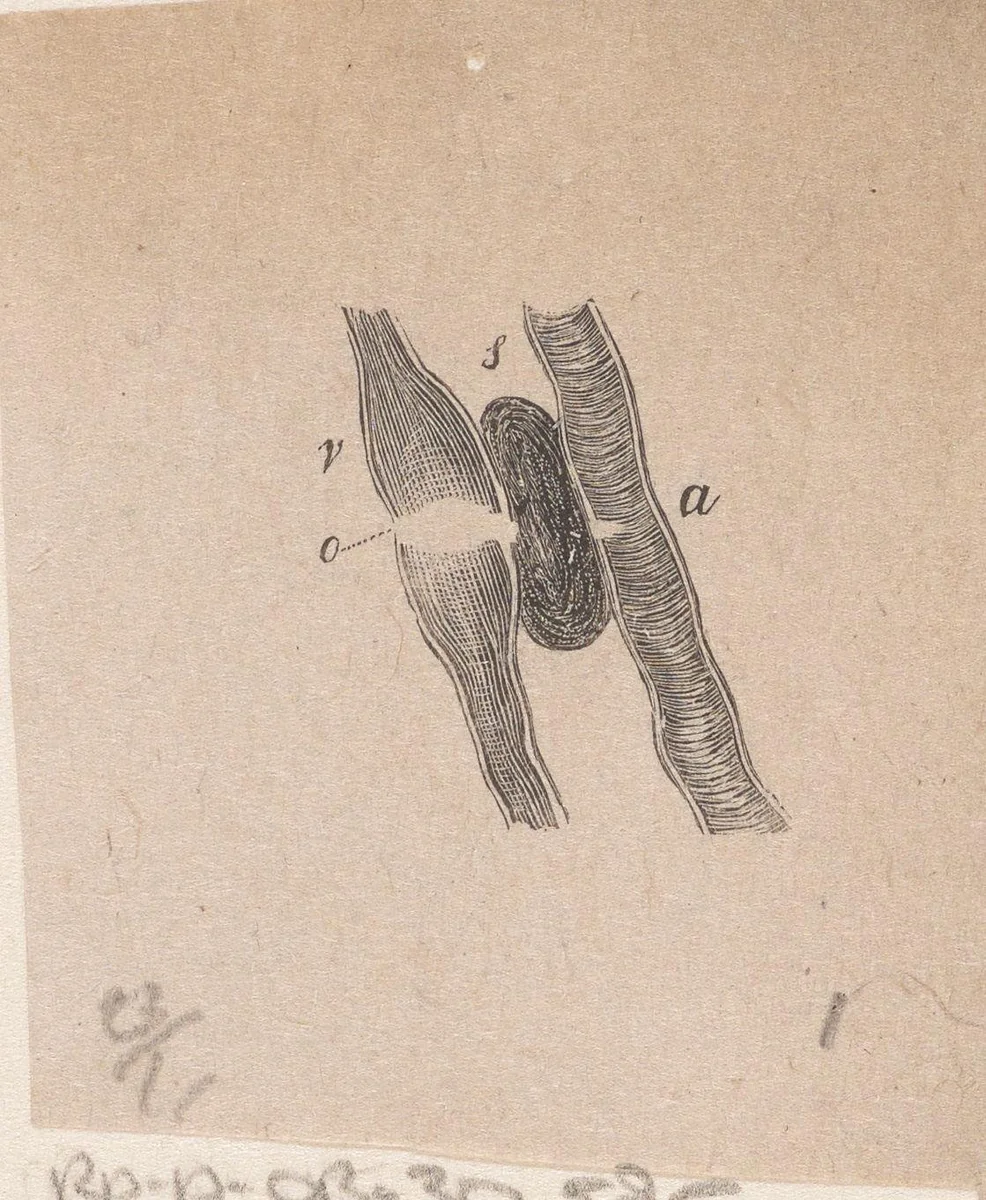 Onderdeel van het menselijk lichaam met een afwijking by Isaac Weissenbruch, print, 1836-1912