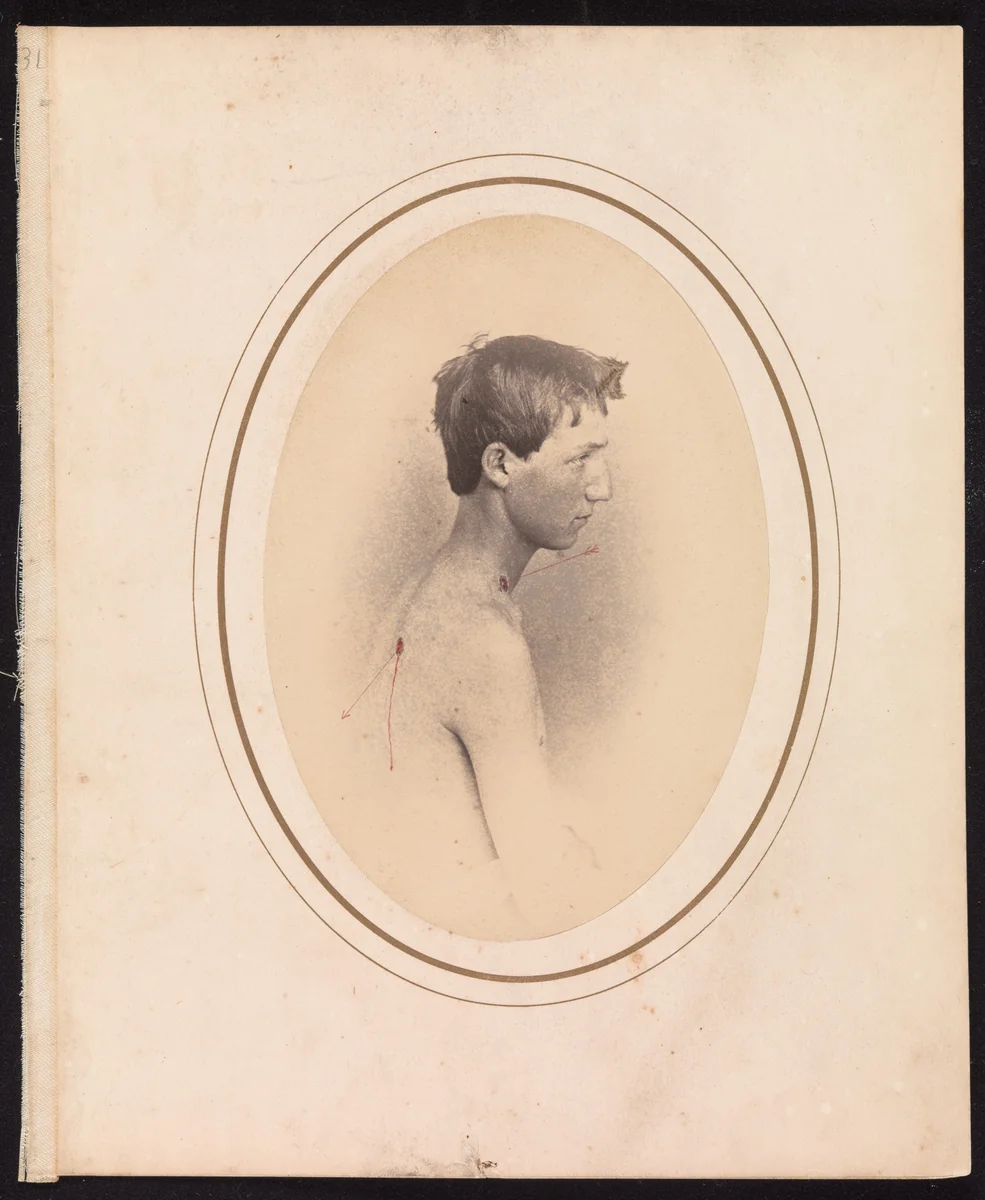 Private Jacob F. Simmons, Company H, Eighty-second Pennsylvania Volunteers by Reed Bontecou, photograph, 1865