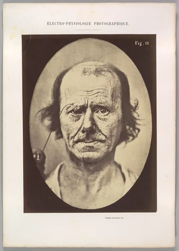 Figure 12: A study of the contraction of and the expression produced by the superior part of m. orbicularis oculi by Guillaume Benjamin Amand Duchenne de Boulogne, photograph, 1854-1856