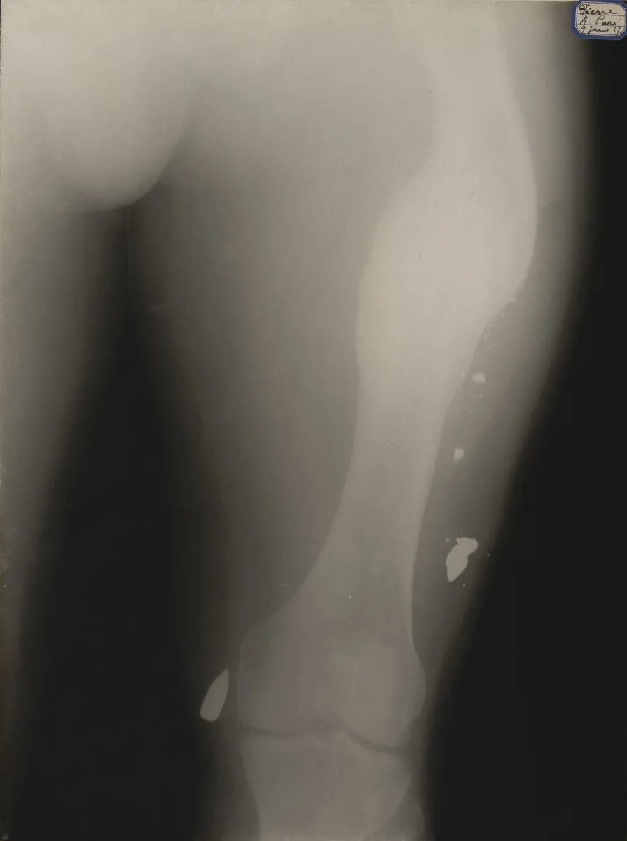 X-Ray by Unidentified Photographer, photograph, 1917