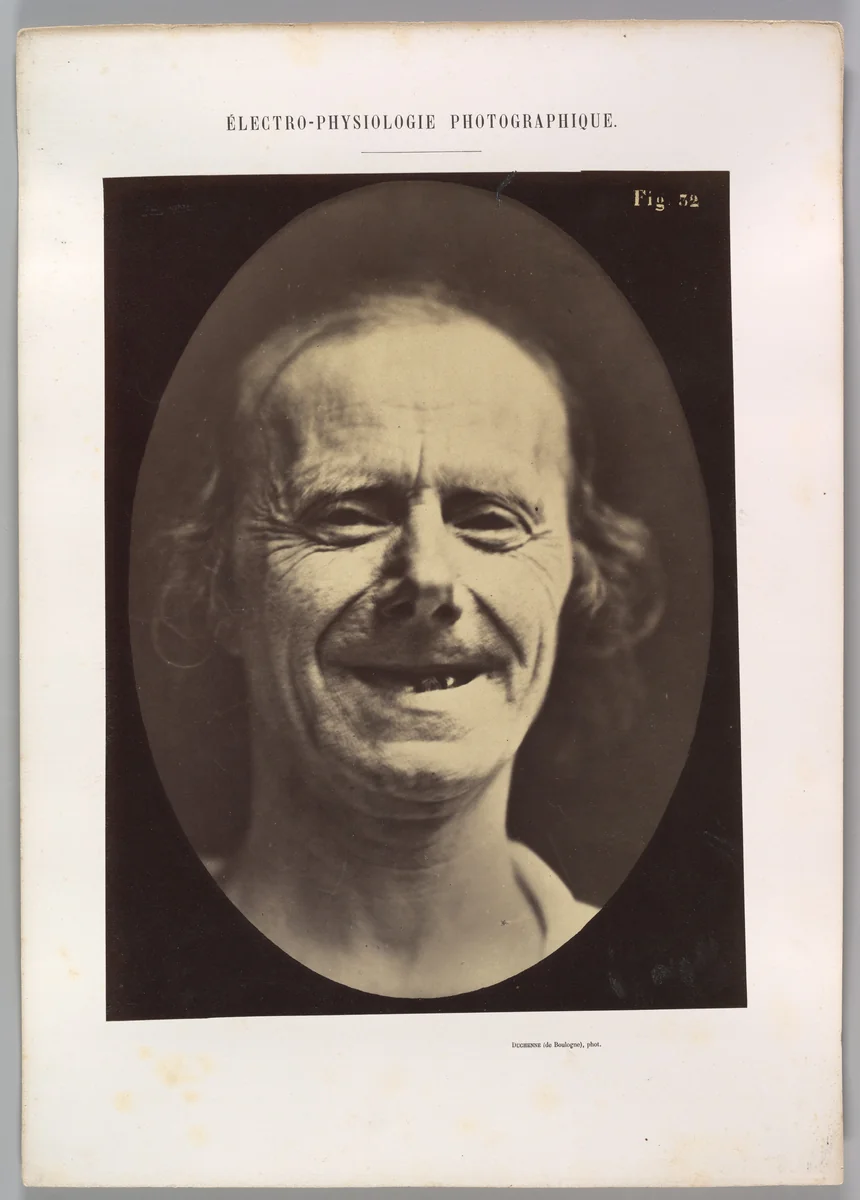 Figure 52: Voluntary retraction of the lower lip by Guillaume Benjamin Amand Duchenne de Boulogne, photograph, 1854-1856
