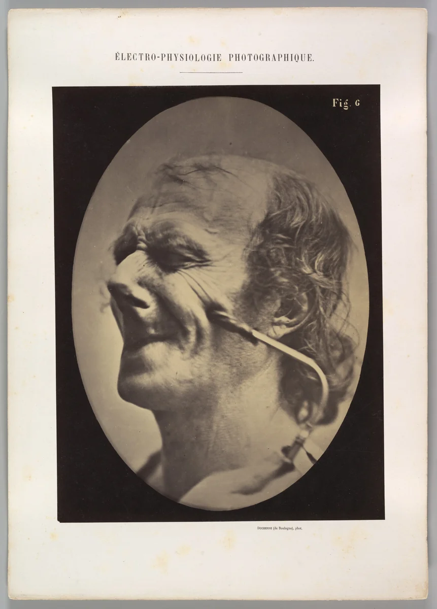 Figure 6: The grimice produced is similar to a tic of the face by Guillaume Benjamin Amand Duchenne de Boulogne, photograph, 1854-1856