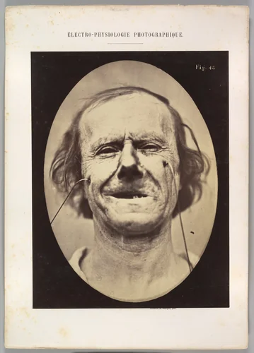Figure 48: Mild weeping, pity and feeble false laughter by Guillaume Benjamin Amand Duchenne de Boulogne, photograph, 1854-1856