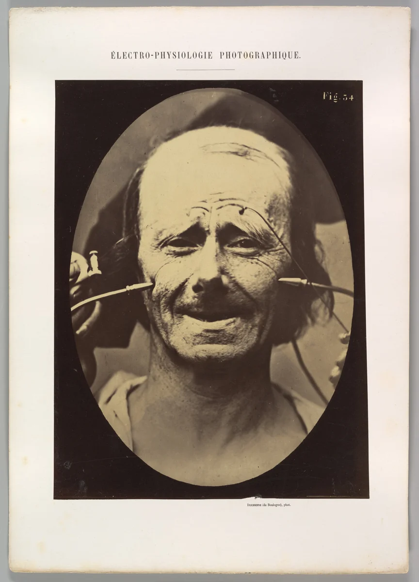 Figure 34: Grimace by Guillaume Benjamin Amand Duchenne de Boulogne, photograph, 1854-1856
