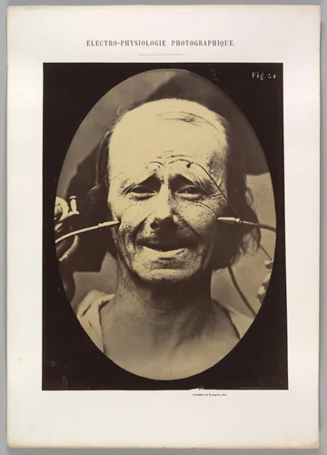 Figure 34: Grimace by Guillaume Benjamin Amand Duchenne de Boulogne, photograph, 1854-1856