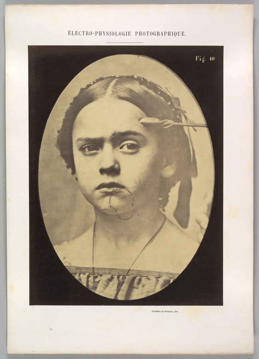 Figure 10: Showing the expressive lines of m. frontalis in a young girl by Guillaume Benjamin Amand Duchenne de Boulogne, photograph, 1854-1856