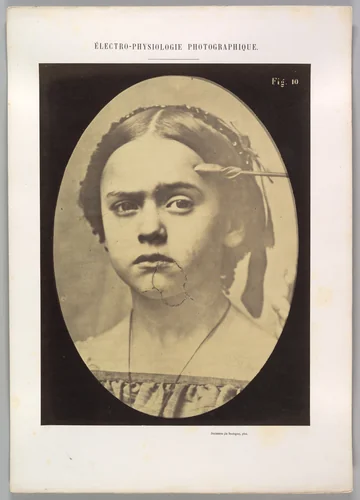 Figure 10: Showing the expressive lines of m. frontalis in a young girl by Guillaume Benjamin Amand Duchenne de Boulogne, photograph, 1854-1856