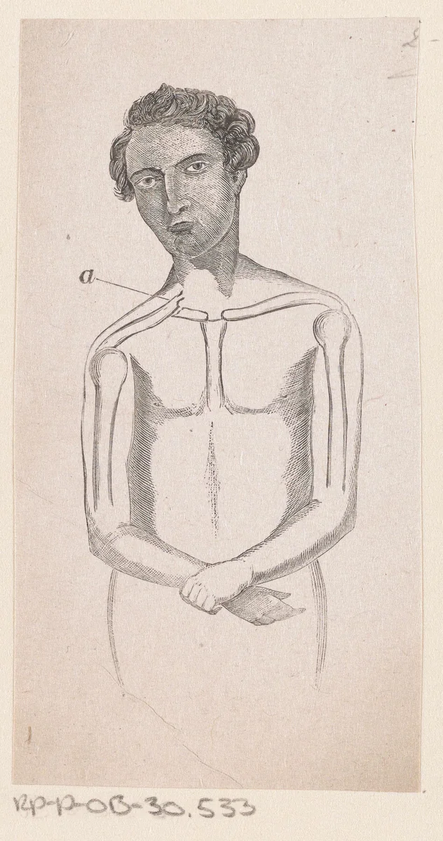 Man met een breuk in het sleutelbeen by Isaac Weissenbruch, print, 1836-1912