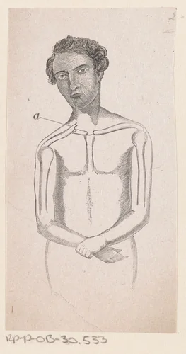 Man met een breuk in het sleutelbeen by Isaac Weissenbruch, print, 1836-1912