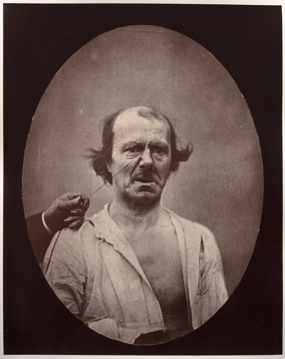 Figure 51: À droite, contraction partielle de l'élévateur commun de l'aile du nez et de la lèvre supérieure: mécontentement, mauvaise humeur; à gauche, repos by Guillaume-Benjamin-Amand Duchenne, photograph, 1851-1861