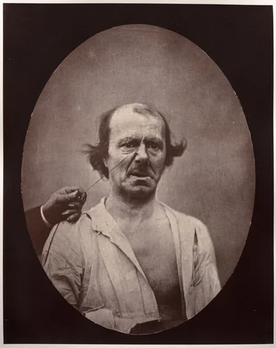 Figure 51: À droite, contraction partielle de l'élévateur commun de l'aile du nez et de la lèvre supérieure: mécontentement, mauvaise humeur; à gauche, repos by Guillaume-Benjamin-Amand Duchenne, photograph, 1851-1861