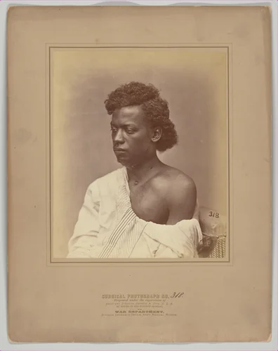Fistulous Openings in the Jaw and Neck by William H. Bell, photograph, 1869