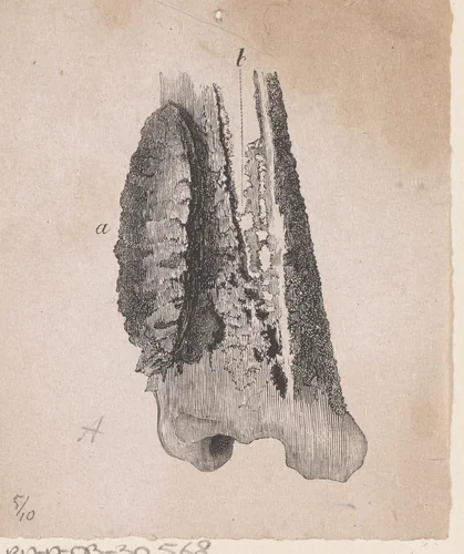 Menselijk bot met een afwijking by Isaac Weissenbruch, print, 1836-1912