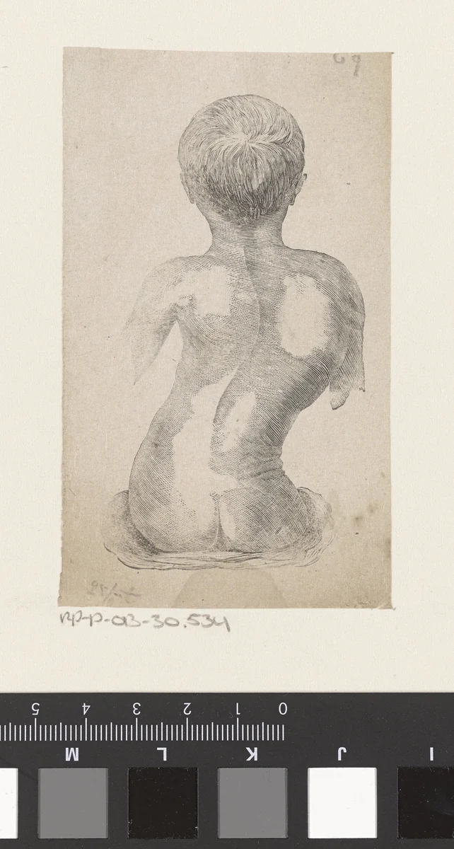 Man met een afwijking in de wervelkolom by Isaac Weissenbruch, print, 1836-1912