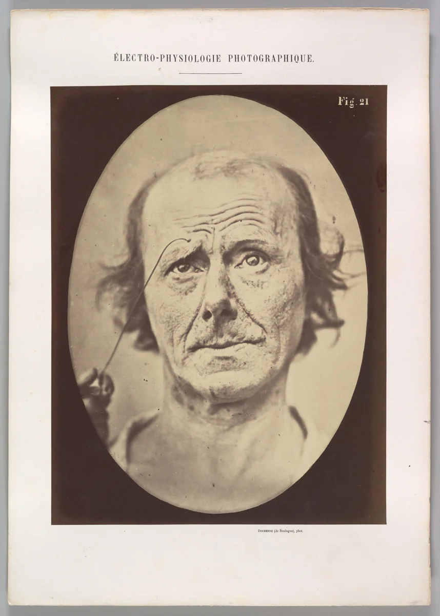 Figure 21: Painful recollection and recollection or calling something to mind by Guillaume Benjamin Amand Duchenne de Boulogne, photograph, 1854-1856