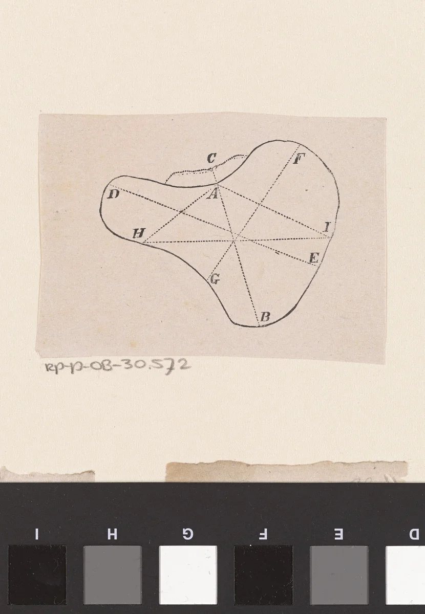 Onderdeel van het menselijk lichaam met een afwijking by Isaac Weissenbruch, print, 1836-1912