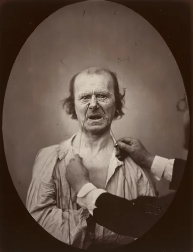 Plate 52 from the chapter The Muscles of Weeping and Wimpering in The Mechanism of Human Facial Expression (1862) by Guillaume Duchenne de Boulogne, Adrien Tournachon, photograph, 1852