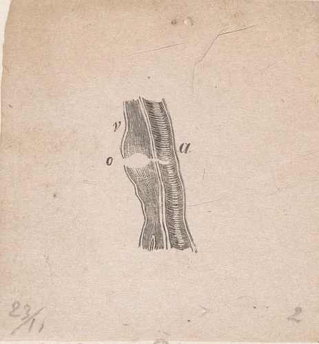 Onderdeel van het menselijk lichaam met een afwijking by Isaac Weissenbruch, print, 1836-1912