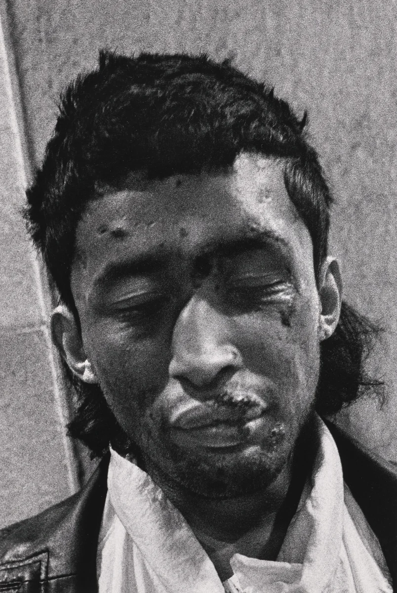 Broken Nose by Jim Goldberg, photograph, 1991