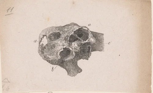 Menselijk bot met een afwijking by Isaac Weissenbruch, print, 1836-1912