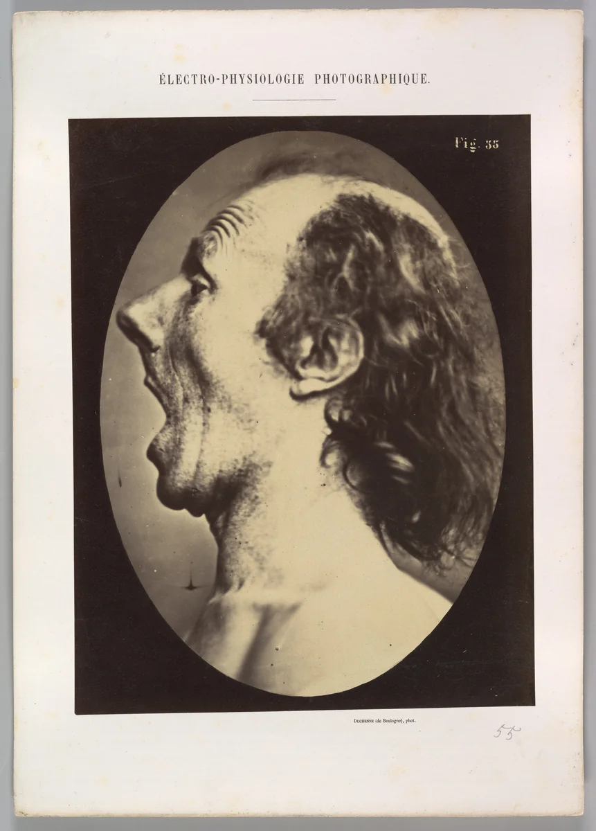 Figure 55: Astonishment badly rendered by the subject: a ridiculous and inane expression. by Guillaume Benjamin Amand Duchenne de Boulogne, photograph, 1854-1856