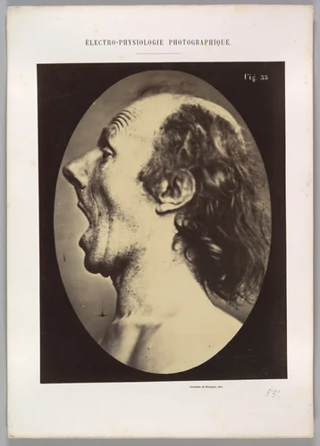 Figure 55: Astonishment badly rendered by the subject: a ridiculous and inane expression. by Guillaume Benjamin Amand Duchenne de Boulogne, photograph, 1854-1856